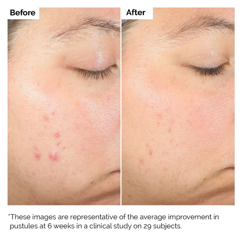 Product image: Salicylic Acid 2% Exfoliating Blemish Solution-null