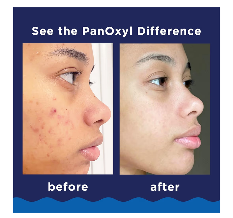 Panoxyl acne foaming wash benzoyl peroxide 10% maximum strength-null
