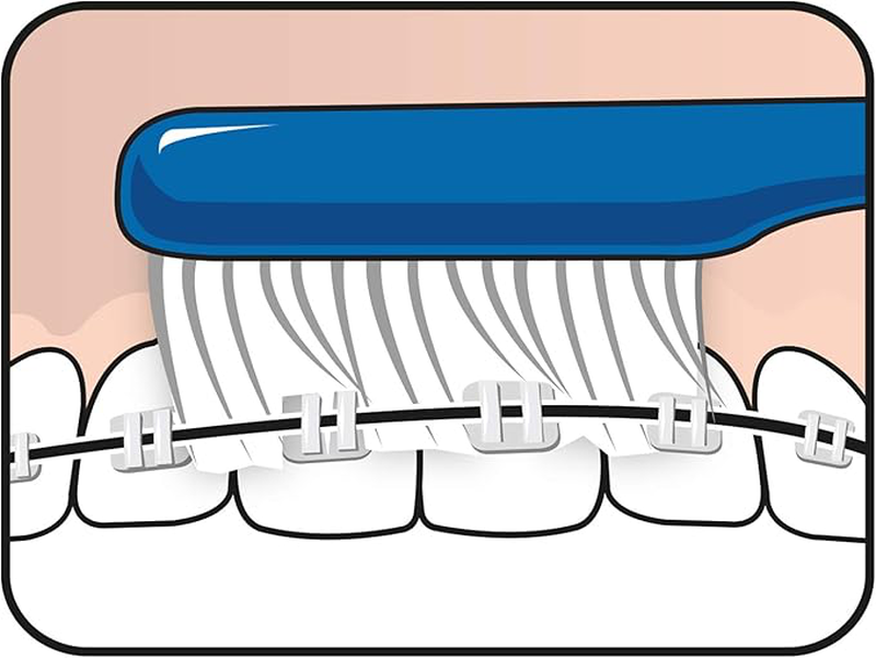 Tepe implant orthodontic extra slim head toothbrush x 1 piece - available in various colours, , medium-null